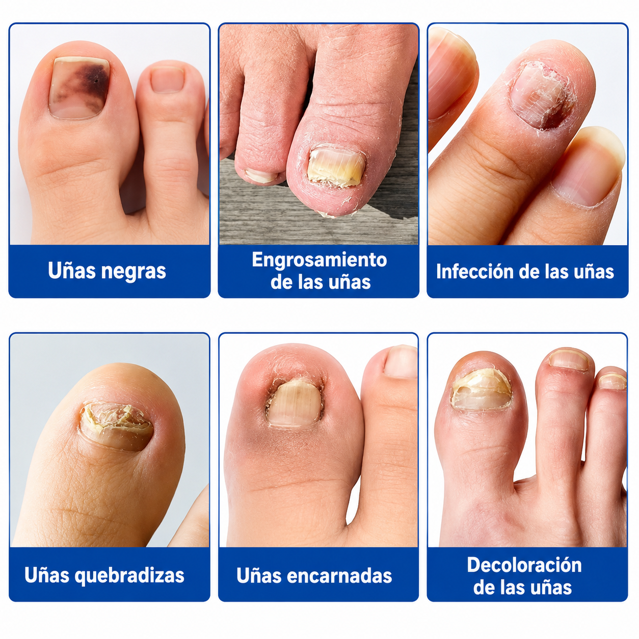 Dispositivo  Láser Antihongos para Uñas de Manos y Pies